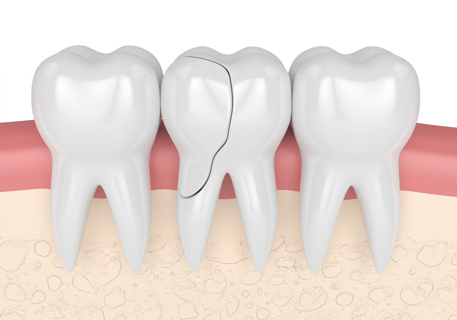 What to Do If You Have a Cracked Molar Atlanta Smiles
