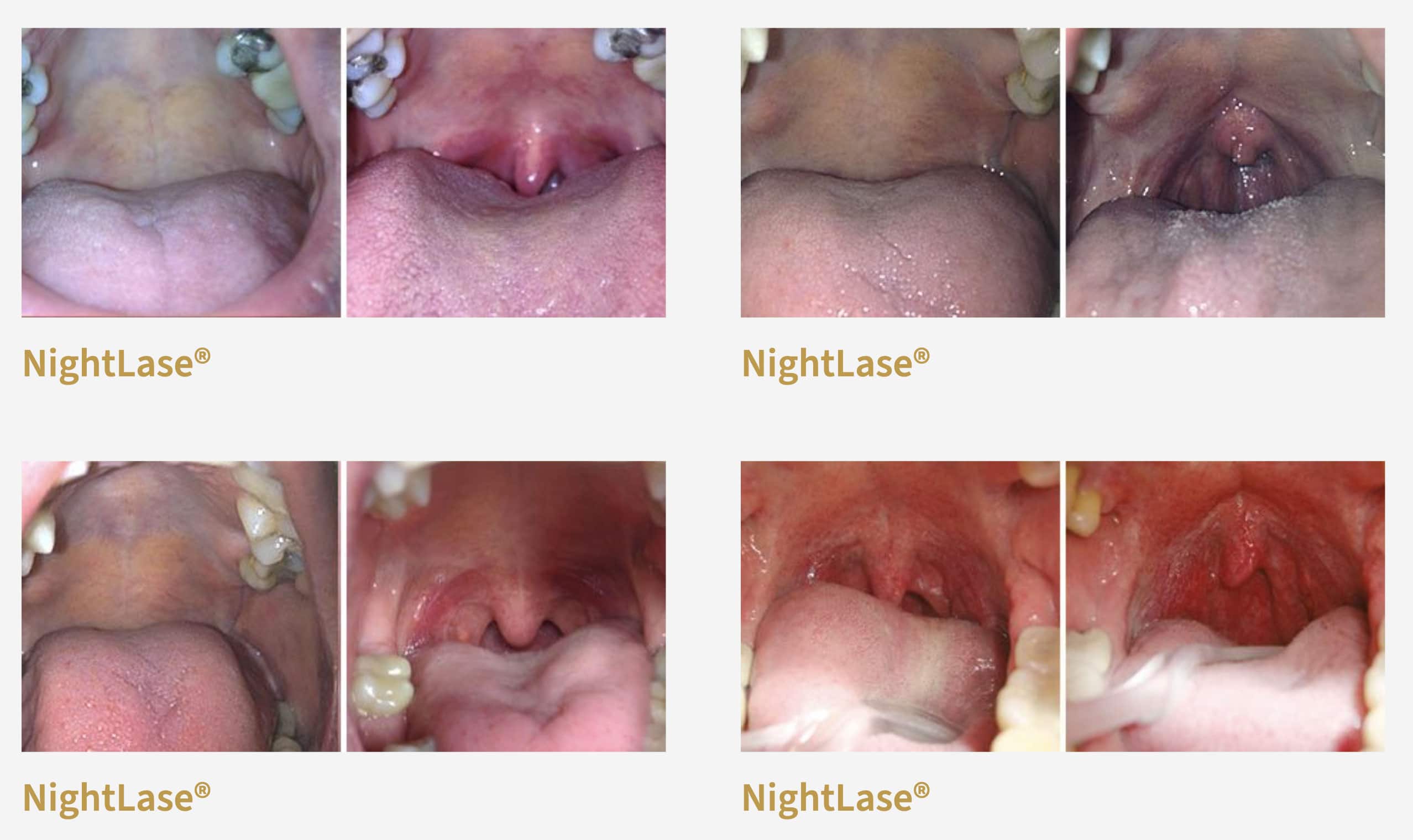 The Fotona LightWalker® II Dental Laser - Stop Snoring Naturally No Cpap needed!