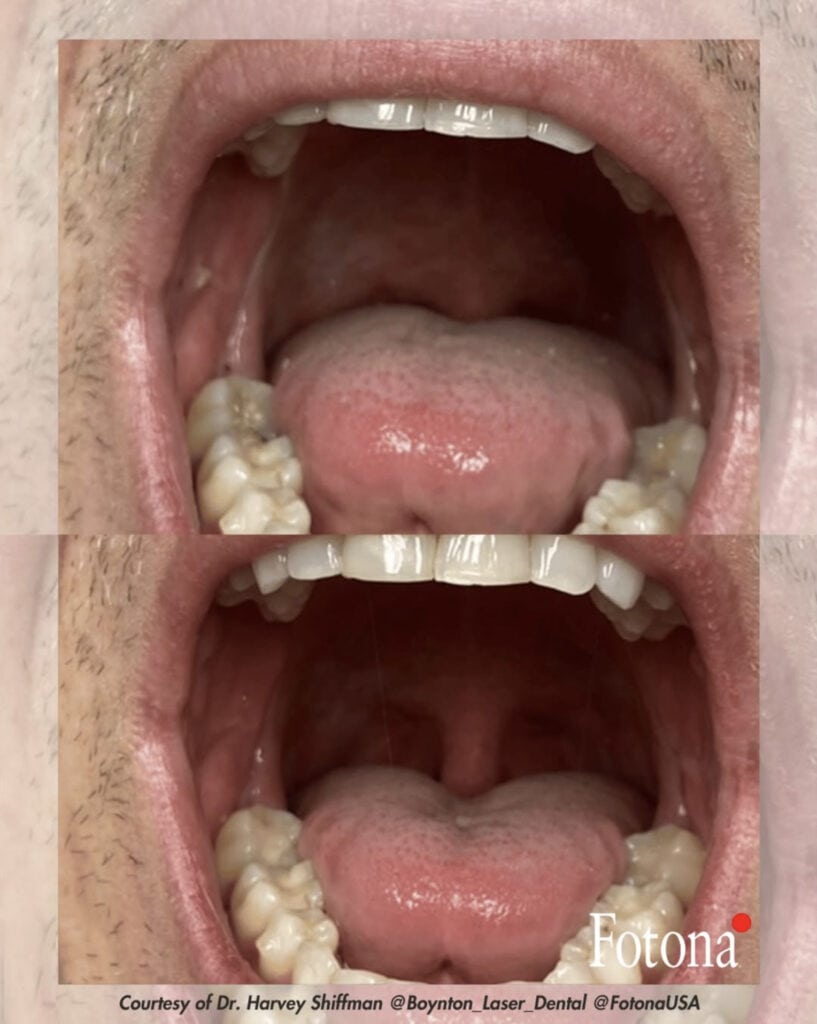 The Fotona LightWalker® II Dental Laser - 1