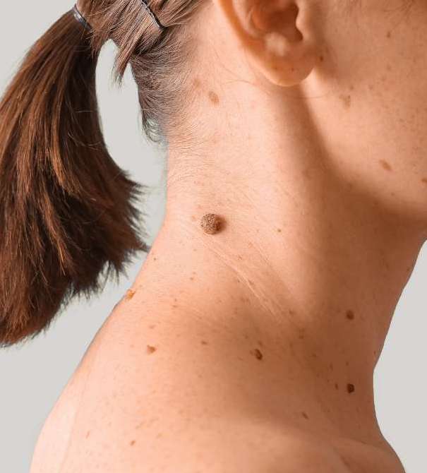 Benefits of Fotona® laser mole & dark spot removal